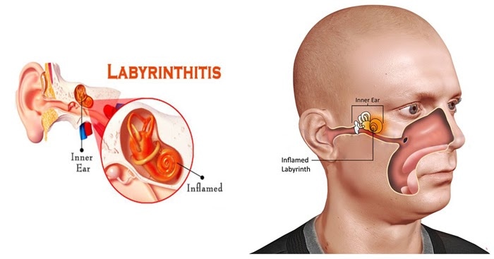 What is Labyrinthitis